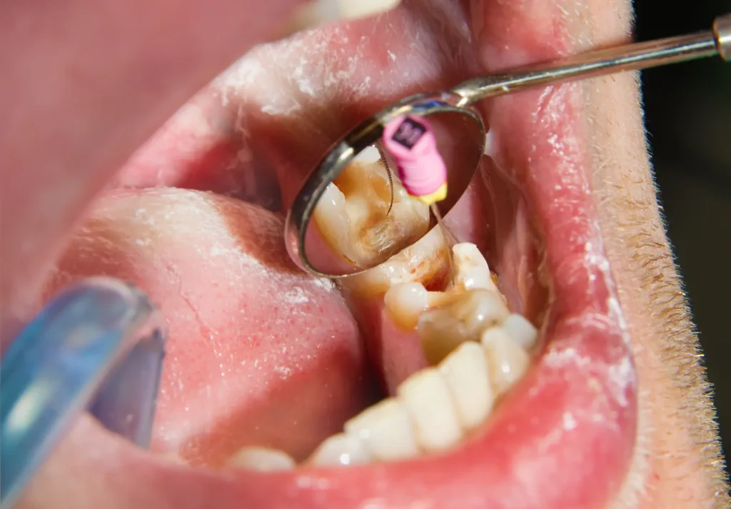 Proceso de odontologo que es endodoncia de parte de Magudent