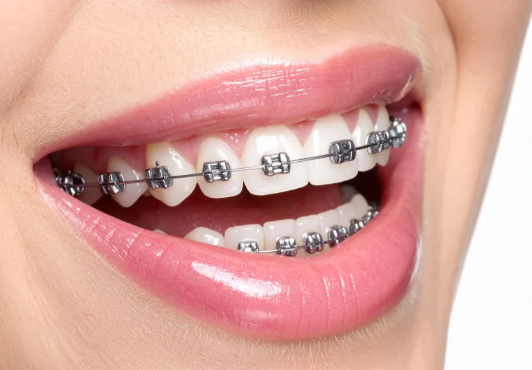 Brackets dentales para corregir la alineación de los dientes y mejorar la sonrisa