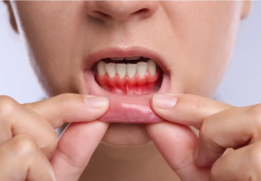 Gingivitis y sangrado de encías