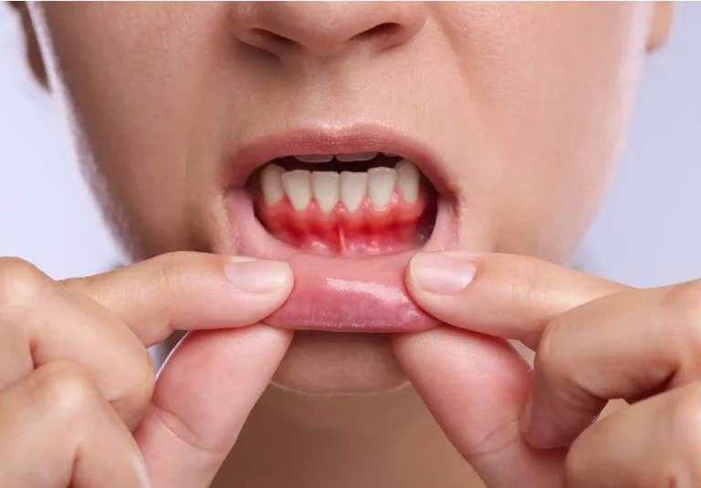 Gingivitis y sangrado de encías